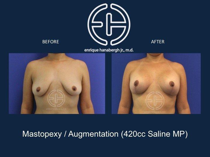 Enrique Hanabergh, MD breast lift result — Miami Lakes, FL