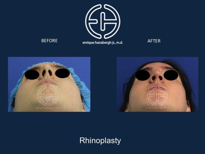 Enrique Hanabergh, MD rhinoplasty result — Miami Lakes, FL