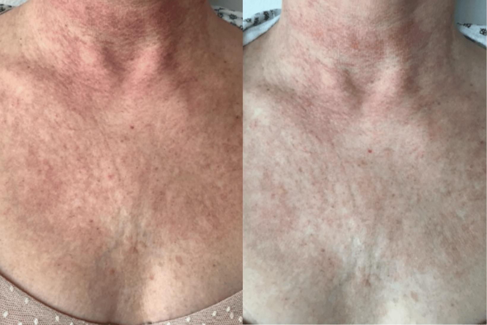 Brightside Aesthetics photofacial result — Clive, IA