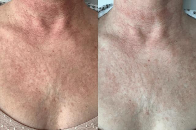 Chemical Peel result at Brightside Aesthetics in Clive, IA