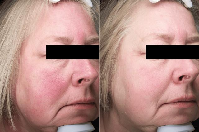 Chemical Peel result at Brightside Aesthetics in Clive, IA