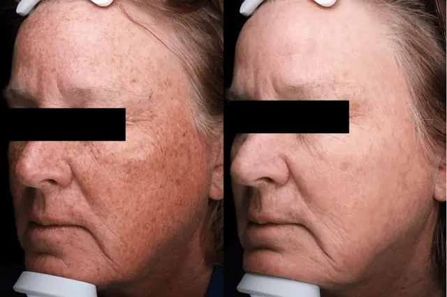 Chemical Peel result at Brightside Aesthetics in Clive, IA