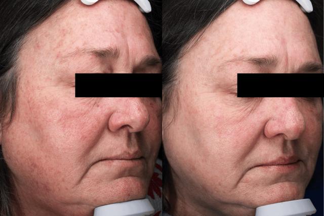 Chemical Peel result at Brightside Aesthetics in Clive, IA
