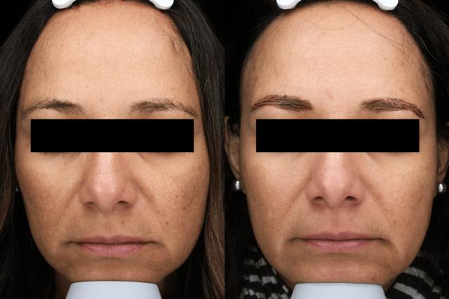 Chemical Peel result at Brightside Aesthetics in Clive, IA