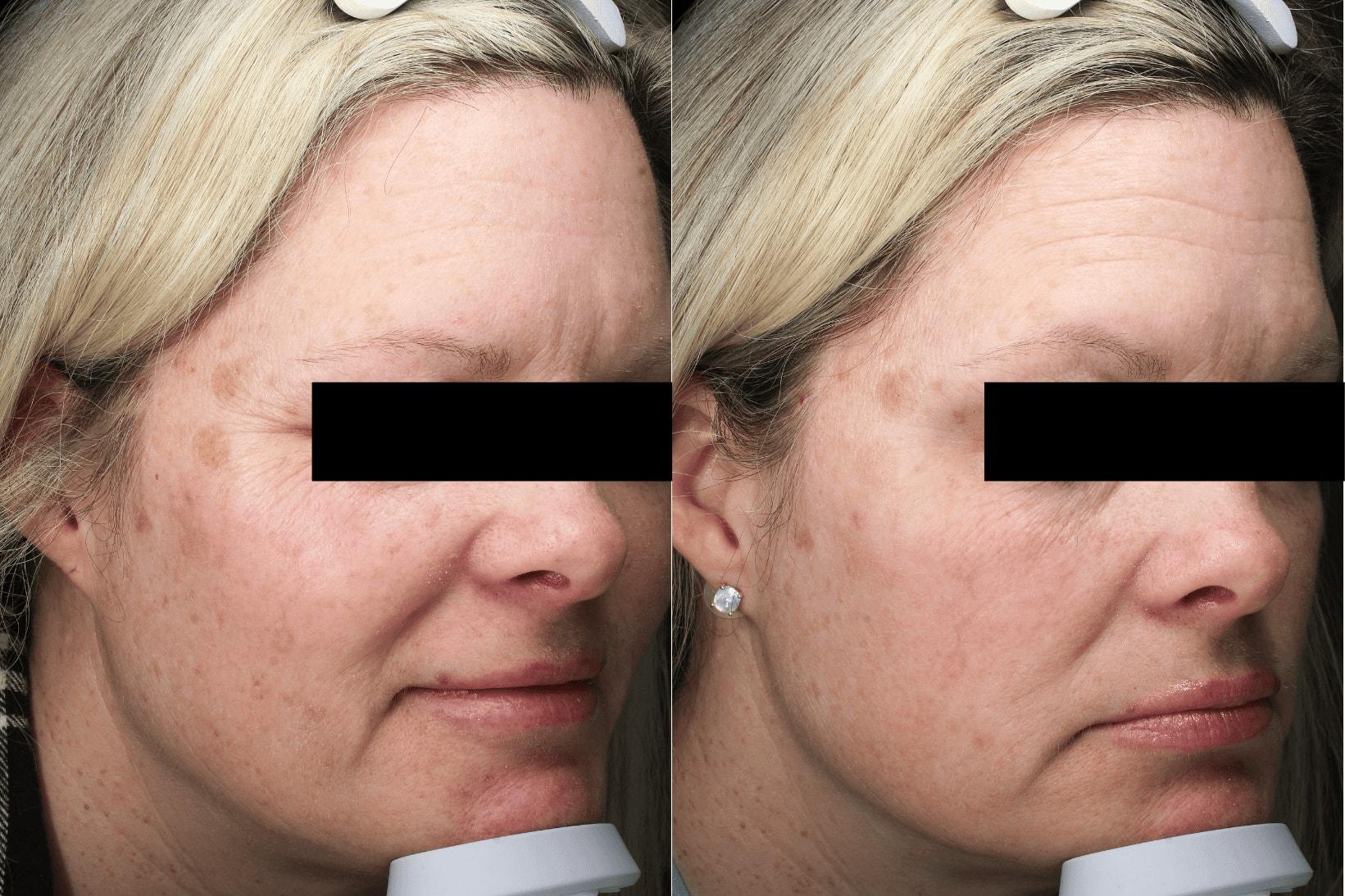 Brightside Aesthetics photofacial result — Clive, IA