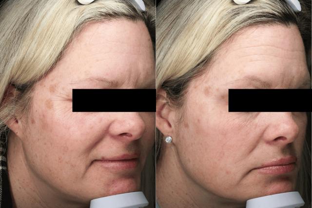 Chemical Peel result at Brightside Aesthetics in Clive, IA