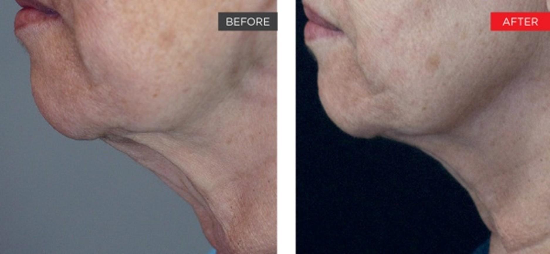 Brightside Aesthetics result — Clive, IA