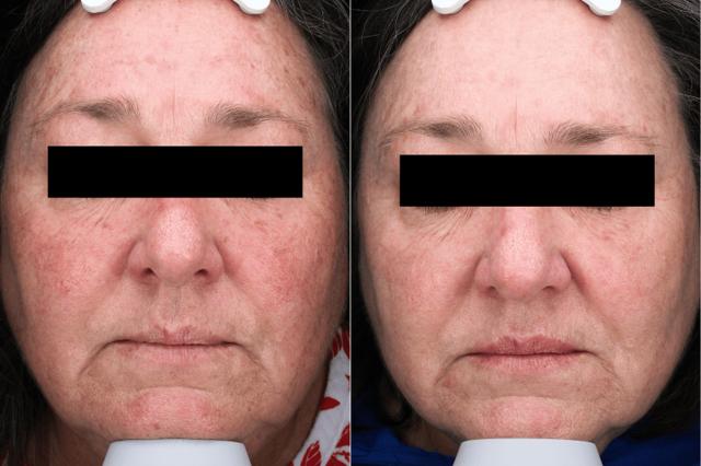 Chemical Peel result at Brightside Aesthetics in Clive, IA