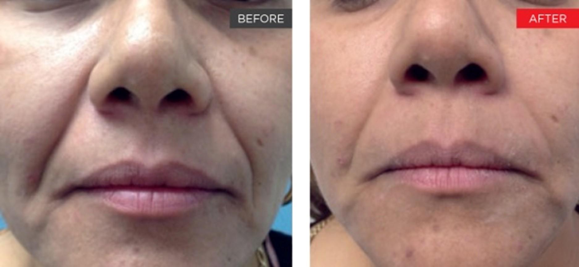Brightside Aesthetics result — Clive, IA