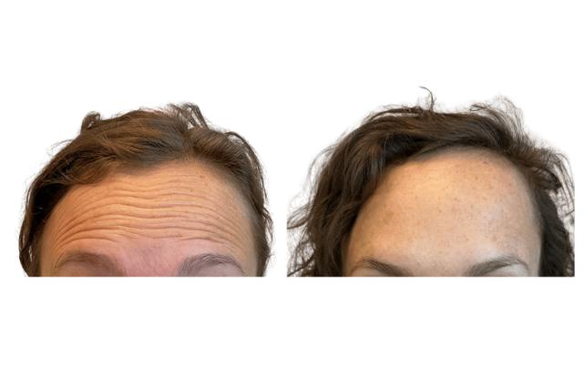 Botox result at Brightside Aesthetics in Clive, IA