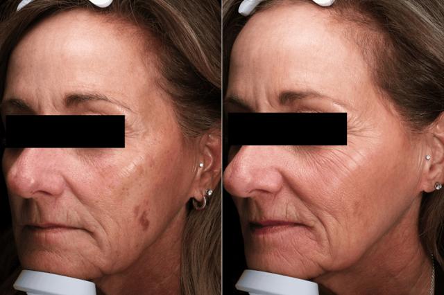 Chemical Peel result at Brightside Aesthetics in Clive, IA