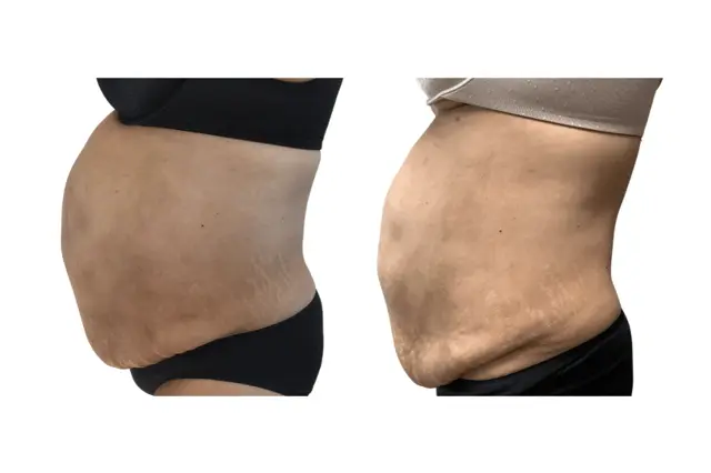 Arm Lift result at Brightside Aesthetics in Clive, IA