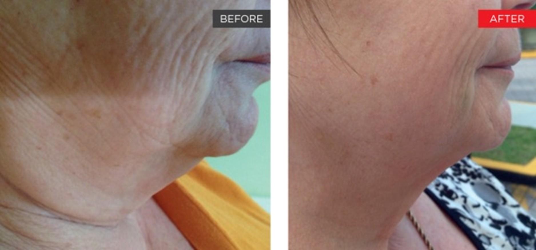 Brightside Aesthetics result — Clive, IA