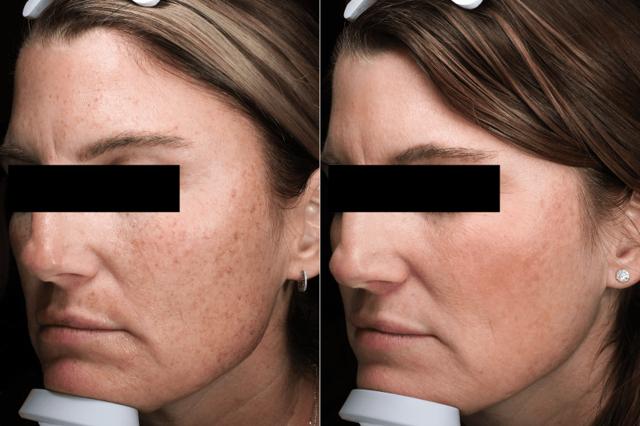 Chemical Peel result at Brightside Aesthetics in Clive, IA