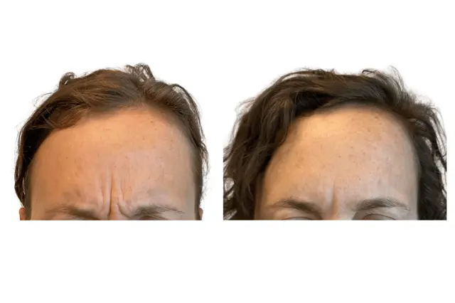 Botox result at Brightside Aesthetics in Clive, IA