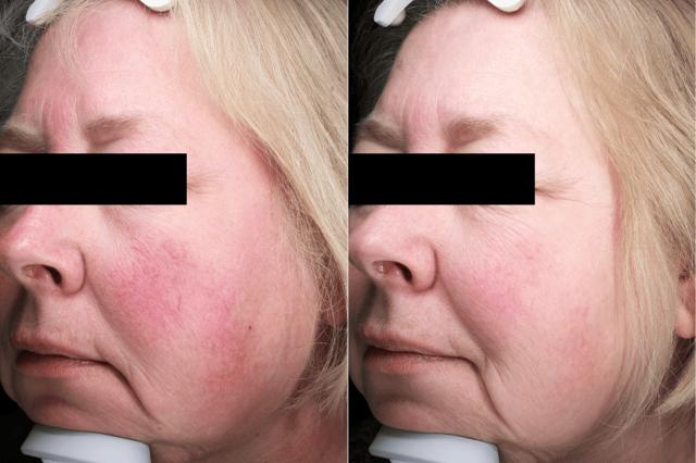 Chemical Peel result at Brightside Aesthetics in Clive, IA