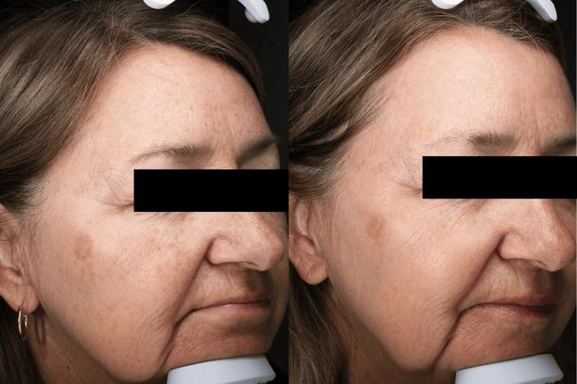 Chemical Peel result at Brightside Aesthetics in Clive, IA
