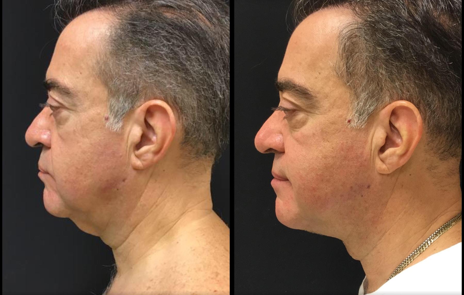 Ariel Ostad, MD neck lift result — New York, NY