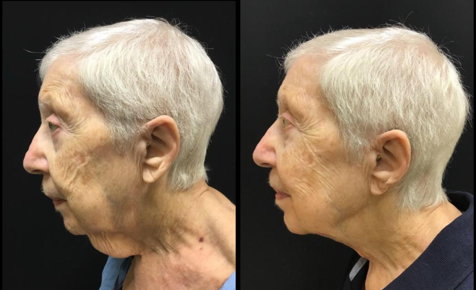Ariel Ostad, MD neck lift result — New York, NY