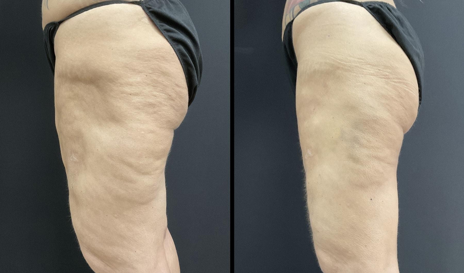 Ariel Ostad, MD fat transfer result — New York, NY