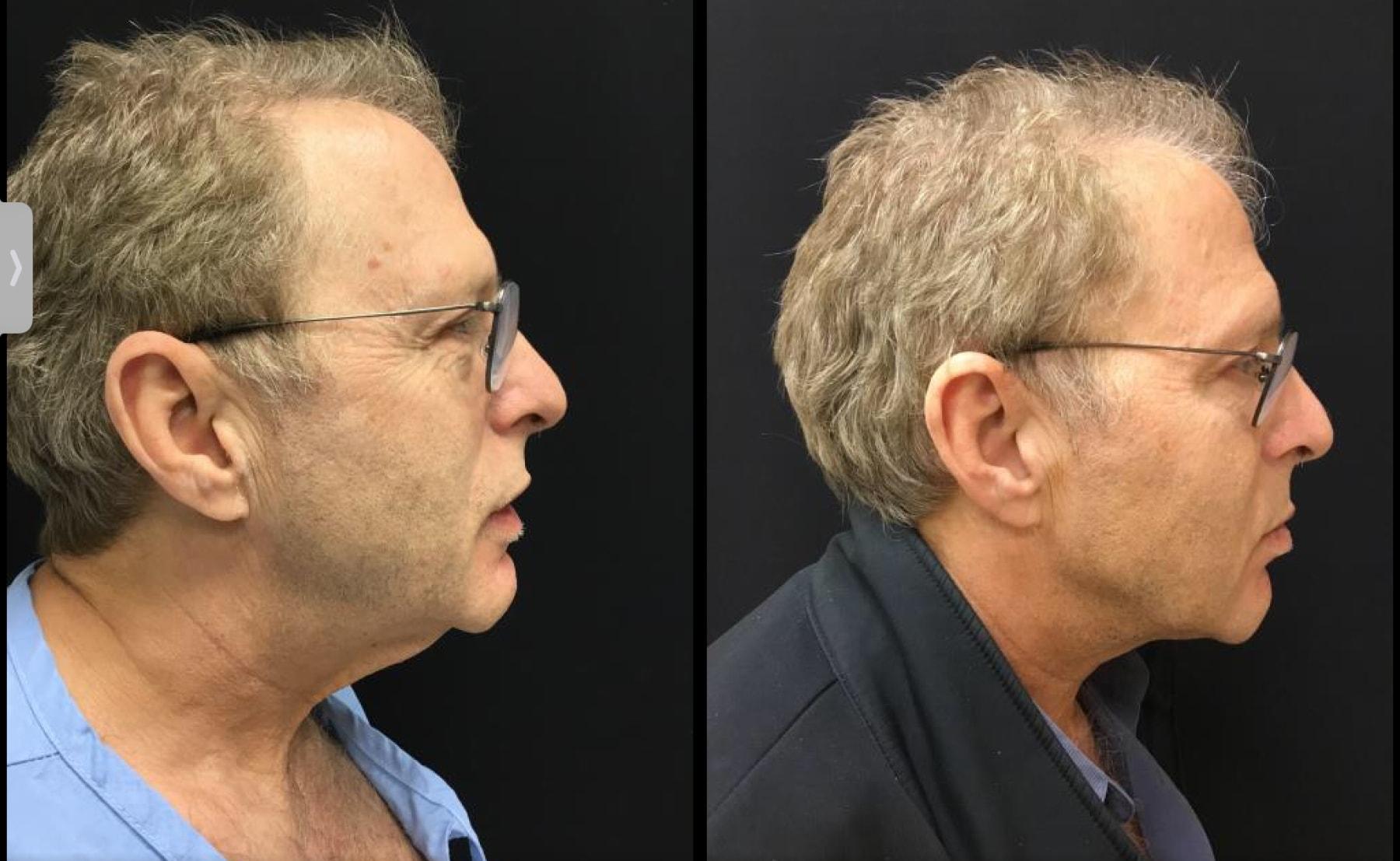 Ariel Ostad, MD neck lift result — New York, NY