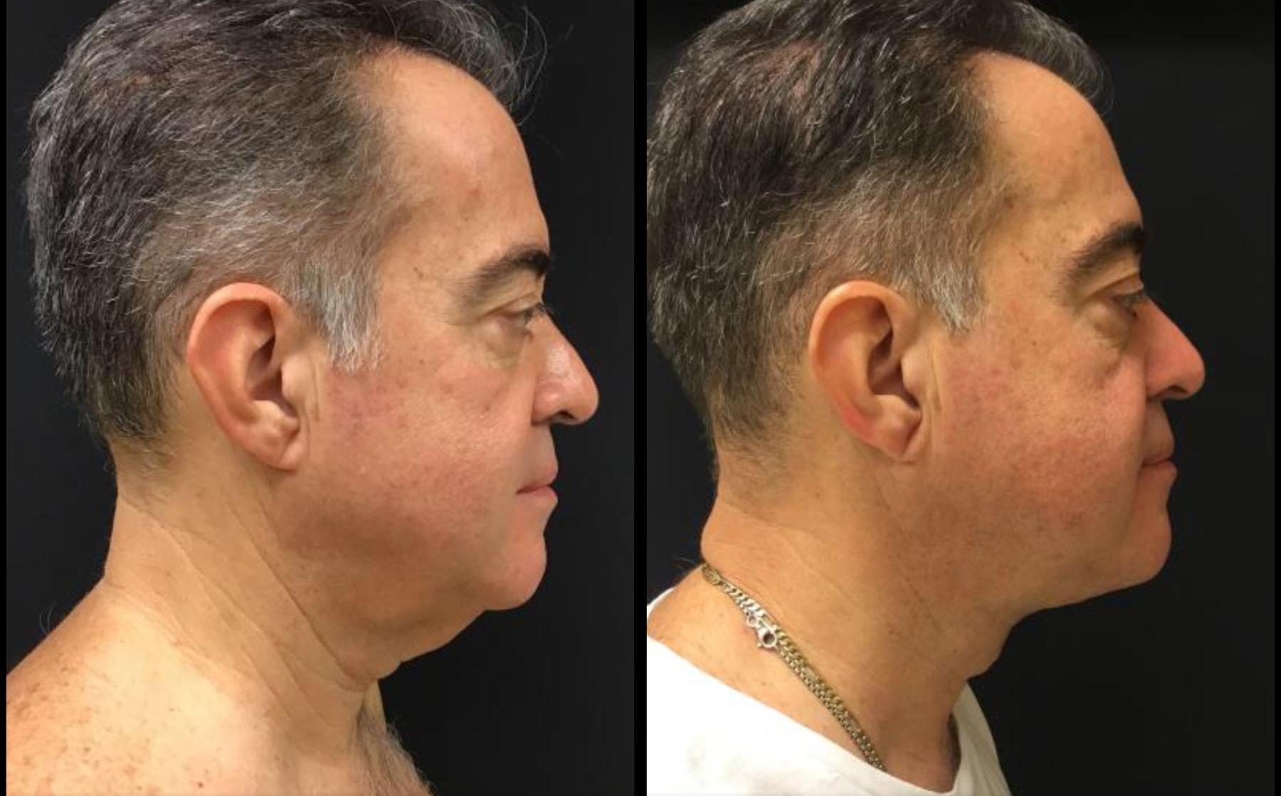 Ariel Ostad, MD neck lift result — New York, NY