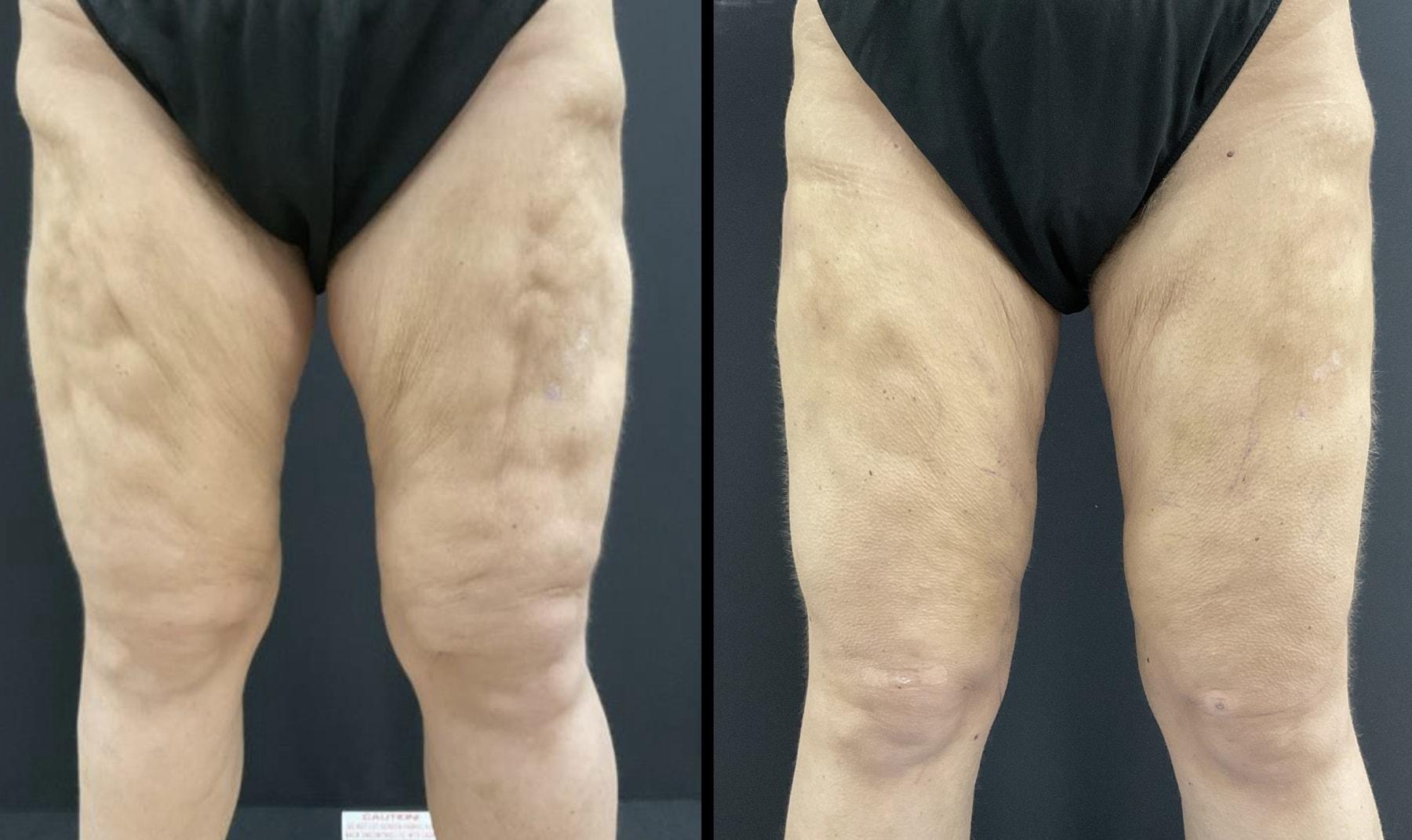 Ariel Ostad, MD fat transfer result — New York, NY