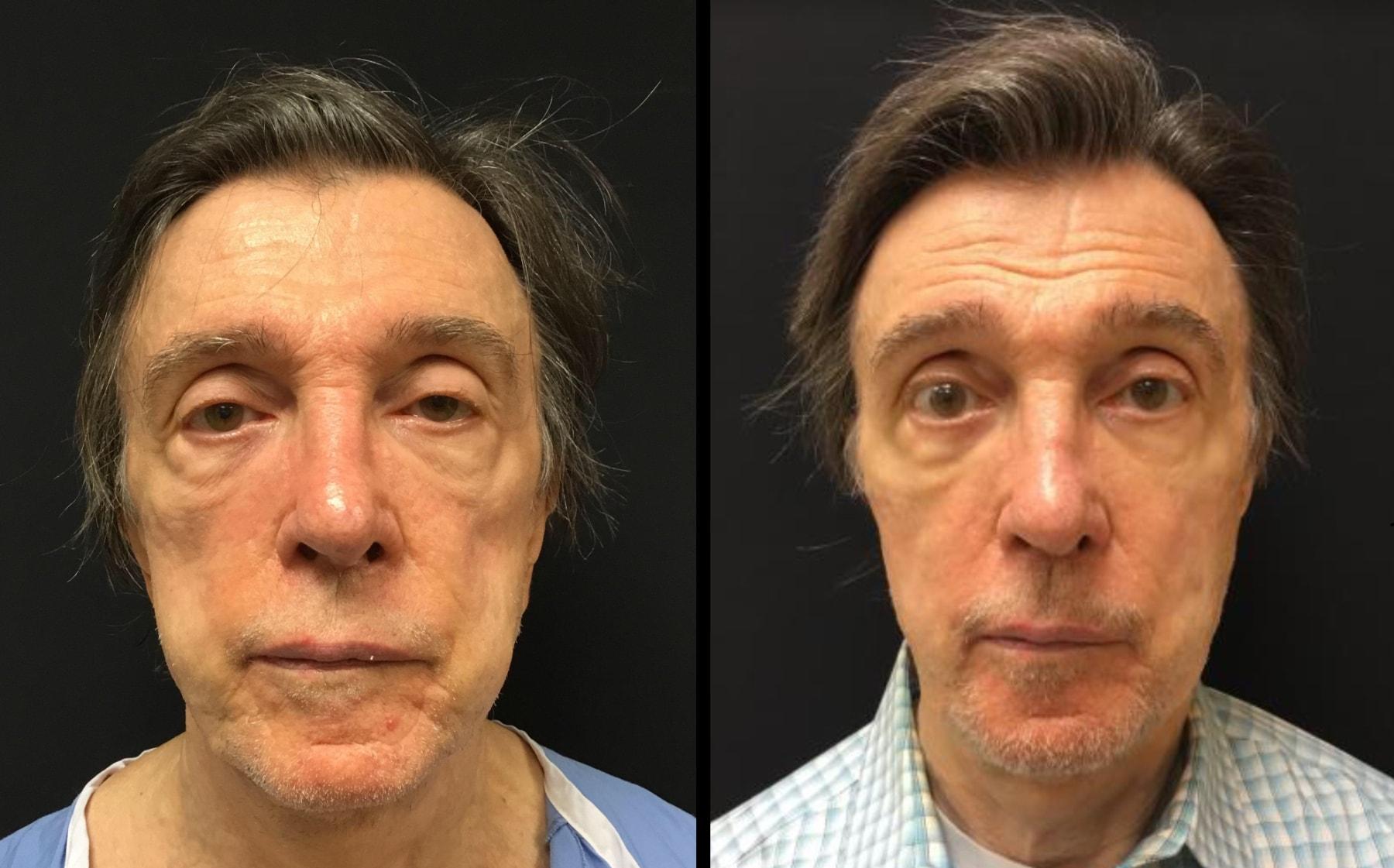 Ariel Ostad, MD fat transfer result — New York, NY