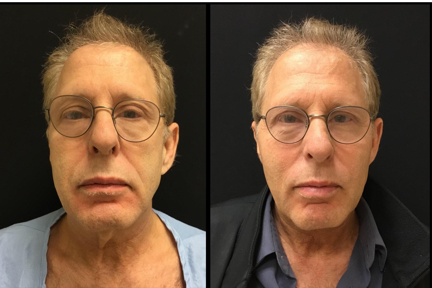 Ariel Ostad, MD neck lift result — New York, NY