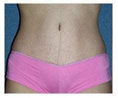 Hoang M Bui, MD tummy tuck after — Orange, CA