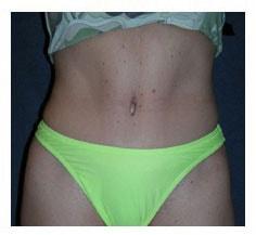 Hoang M Bui, MD tummy tuck after — Orange, CA