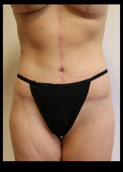 Kelly R. Kunkel, MD, PA tummy tuck after — Fort Worth, TX