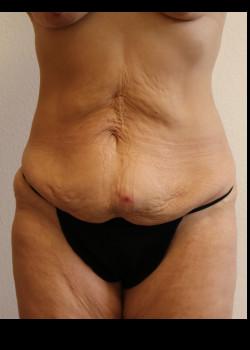 Tummy Tuck before at Kelly R. Kunkel, MD, PA in Fort Worth, TX