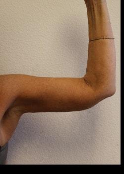Arm Lift after at Kelly R. Kunkel, MD, PA in Fort Worth, TX