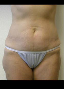 Tummy Tuck before at Kelly R. Kunkel, MD, PA in Fort Worth, TX