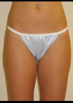 Liposuction after at Kelly R. Kunkel, MD, PA in Fort Worth, TX
