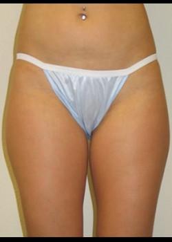 Liposuction before at Kelly R. Kunkel, MD, PA in Fort Worth, TX