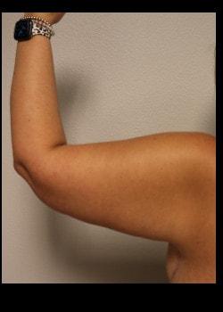 Arm Lift after at Kelly R. Kunkel, MD, PA in Fort Worth, TX
