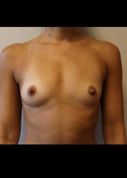 Breast Augmentation before at Kelly R. Kunkel, MD, PA in Fort Worth, TX