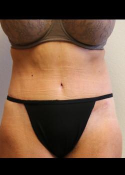 Tummy Tuck after at Kelly R. Kunkel, MD, PA in Fort Worth, TX