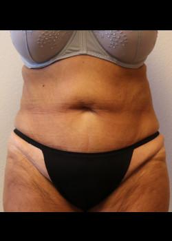 Tummy Tuck before at Kelly R. Kunkel, MD, PA in Fort Worth, TX