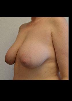 Breast Lift before at Kelly R. Kunkel, MD, PA in Fort Worth, TX