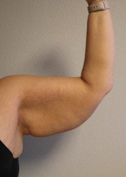 Arm Lift before at Kelly R. Kunkel, MD, PA in Fort Worth, TX