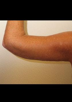 Arm Lift after at Kelly R. Kunkel, MD, PA in Fort Worth, TX