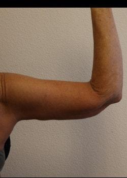 Arm Lift after at Kelly R. Kunkel, MD, PA in Fort Worth, TX