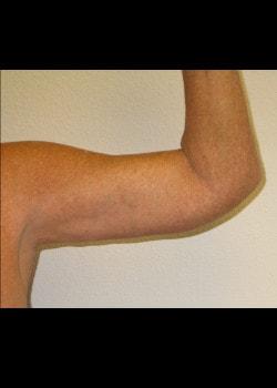 Arm Lift after at Kelly R. Kunkel, MD, PA in Fort Worth, TX