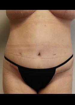 Kelly R. Kunkel, MD, PA tummy tuck after — Fort Worth, TX