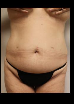 Tummy Tuck before at Kelly R. Kunkel, MD, PA in Fort Worth, TX