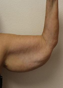 Arm Lift before at Kelly R. Kunkel, MD, PA in Fort Worth, TX