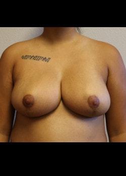 Breast Reduction after at Kelly R. Kunkel, MD, PA in Fort Worth, TX
